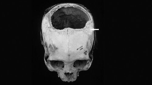 穿颅治病古已有之