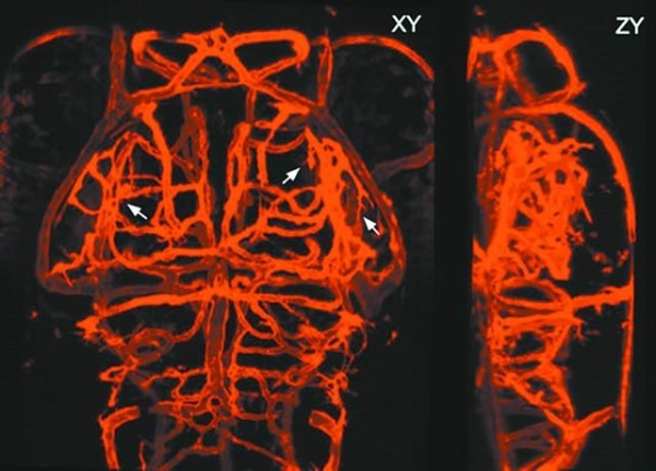 脑血管三维成像图片